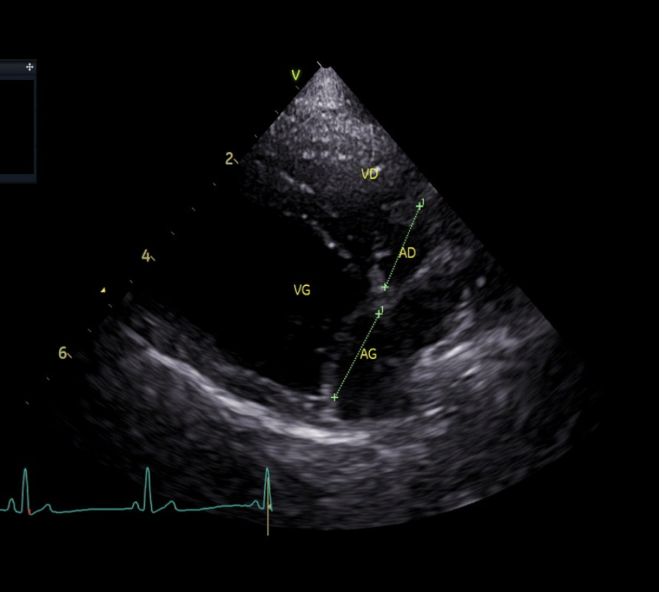 Consultation et échographie cardiaque
